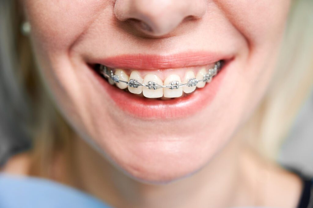 high-quality orthodontic braces in hong kong