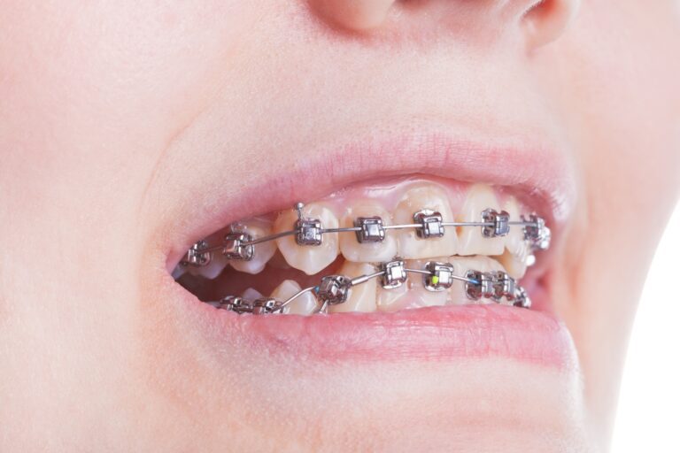 self-ligating braces treatment in hong kong