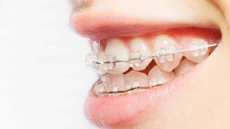 Clean Ceramic Braces