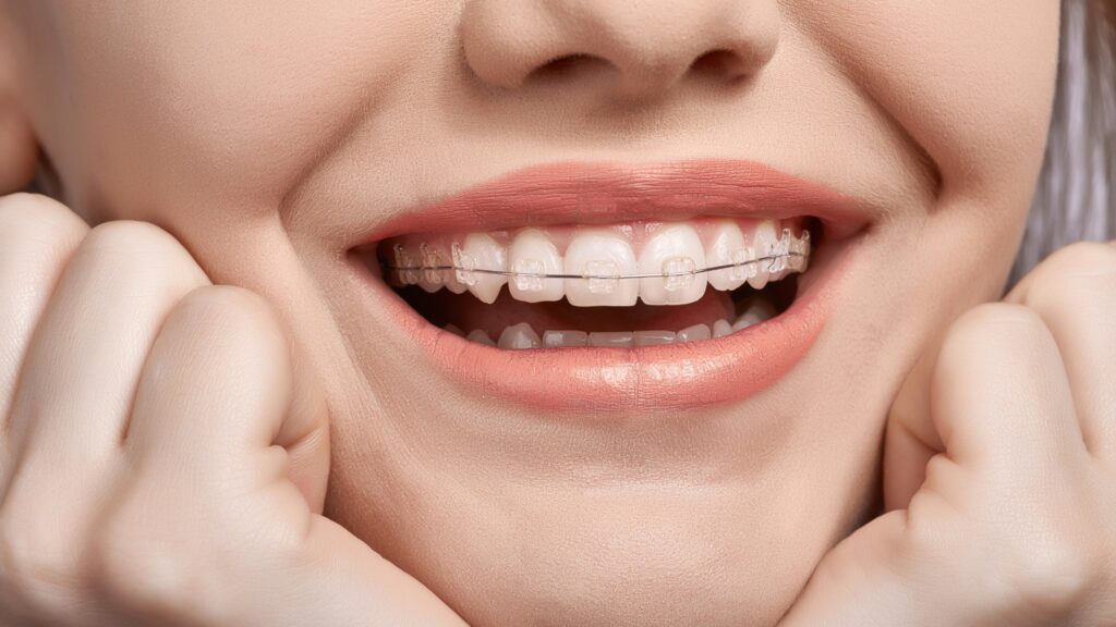 Clean Ceramic Braces