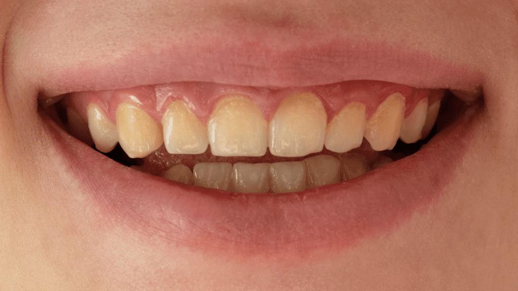 Dealing with Stains on Ceramic Braces: Causes and Solutions