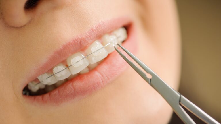 Common Cleaning Mistakes to Avoid with Ceramic Braces
